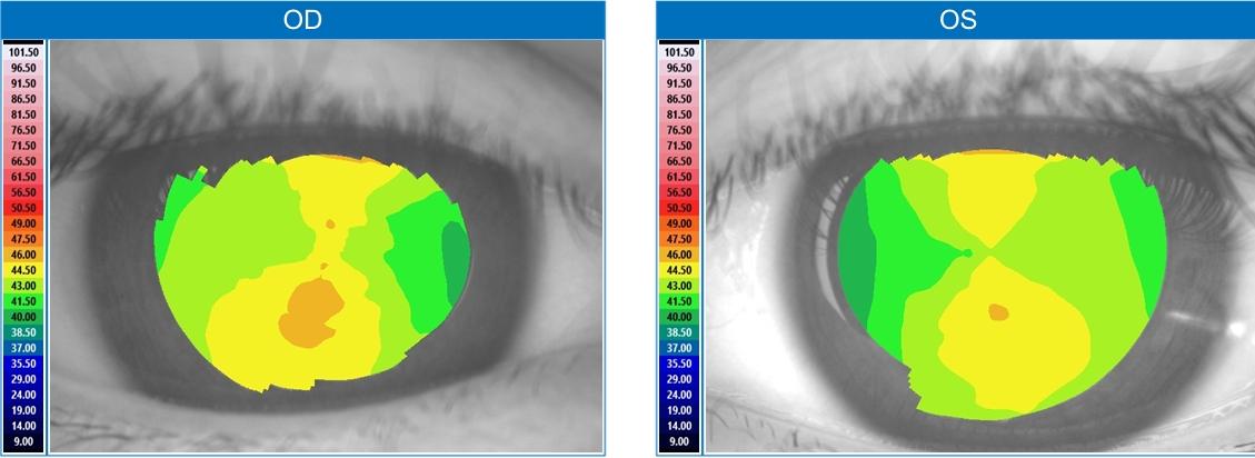 Corneal topography map