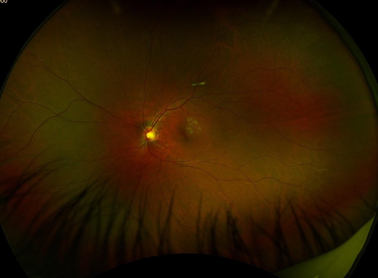 Optomap image of a child's retina